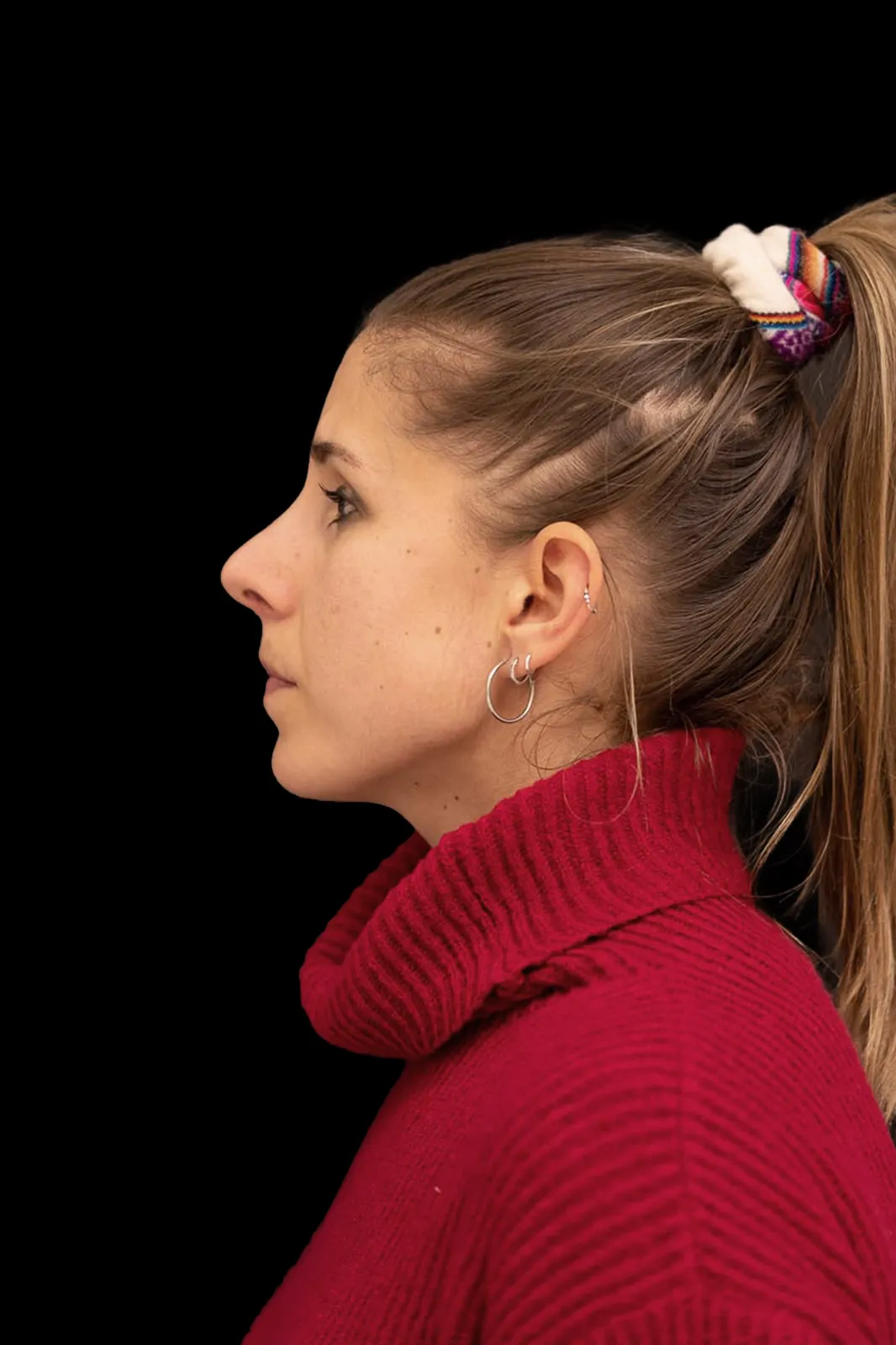 Rinoplastia en Barcelona — resultado (después)
