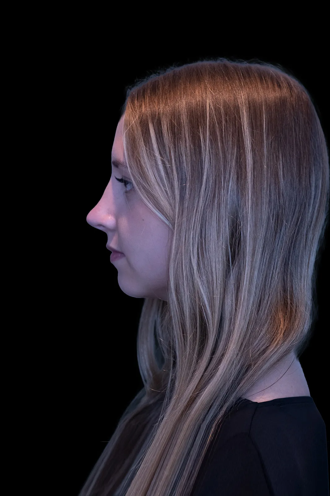 Rinoplastia en Barcelona — antes
