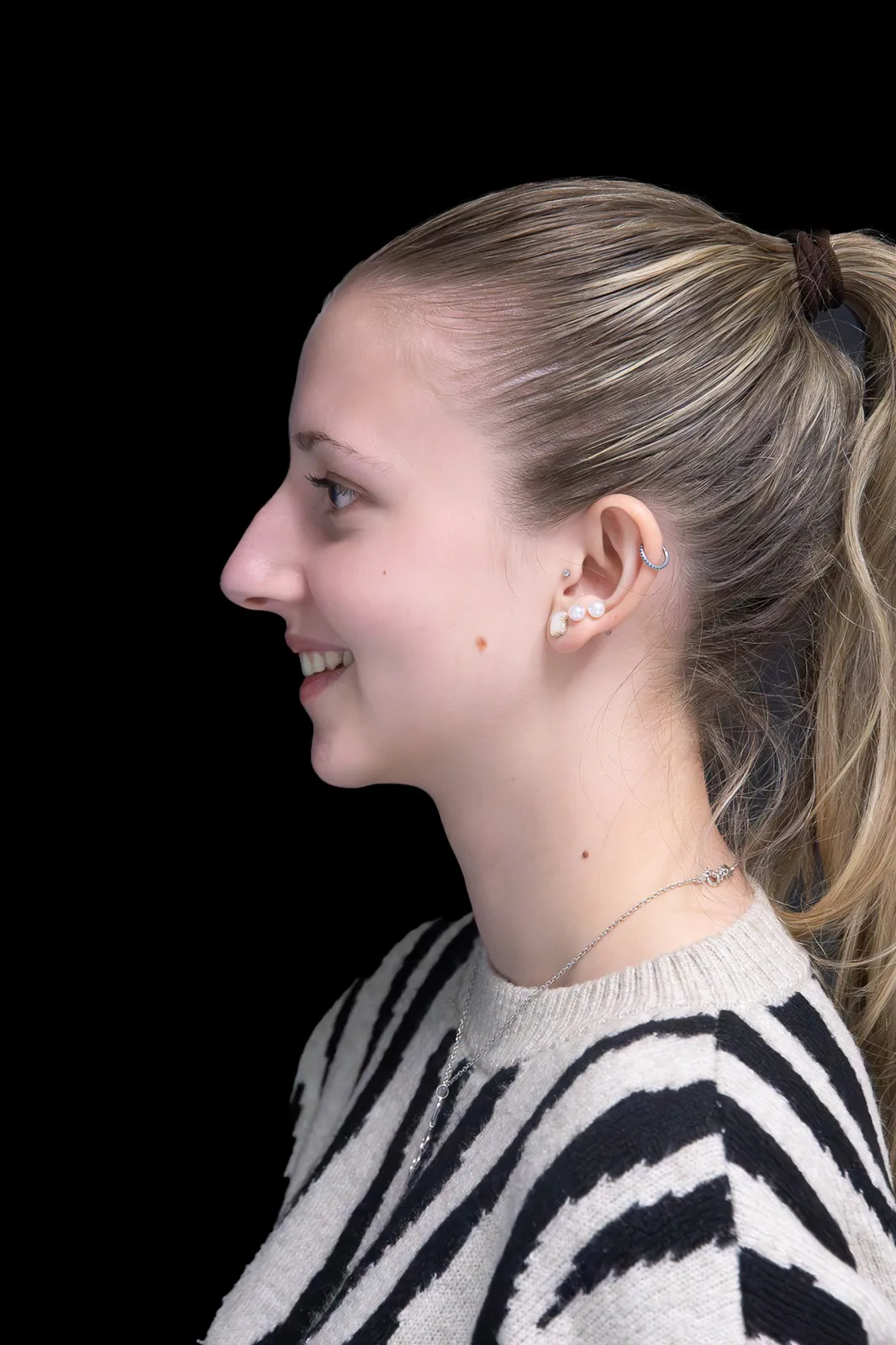 Rinoplastia en Barcelona — resultado (después)