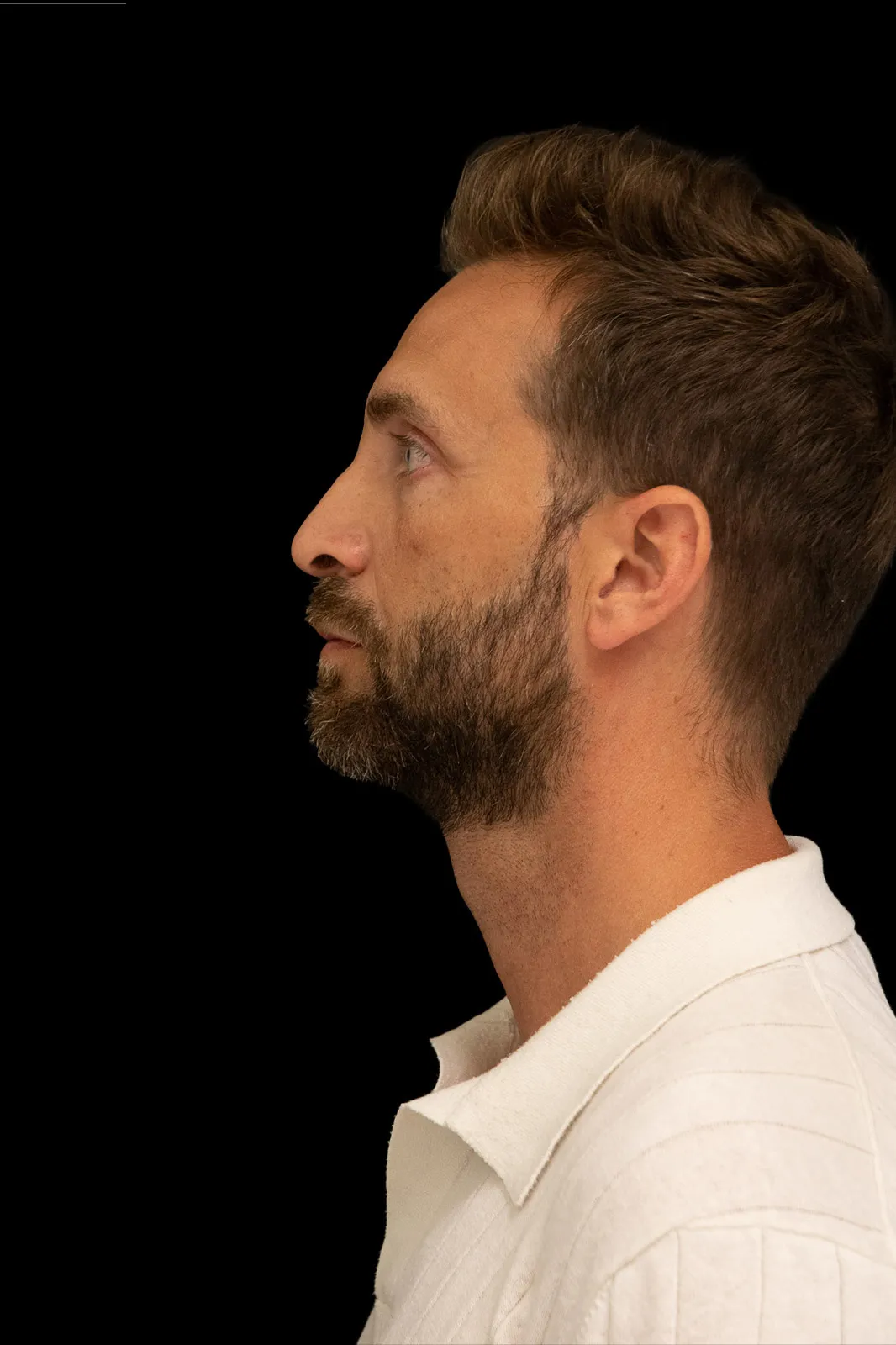 Rinoplastia en Barcelona — antes