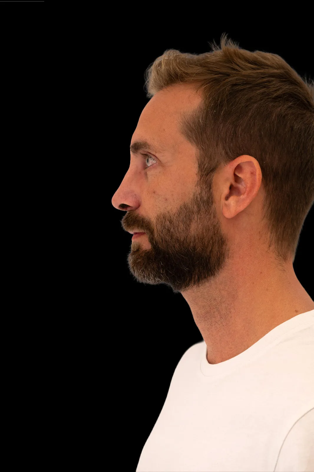 Rinoplastia en Barcelona — resultado (después)